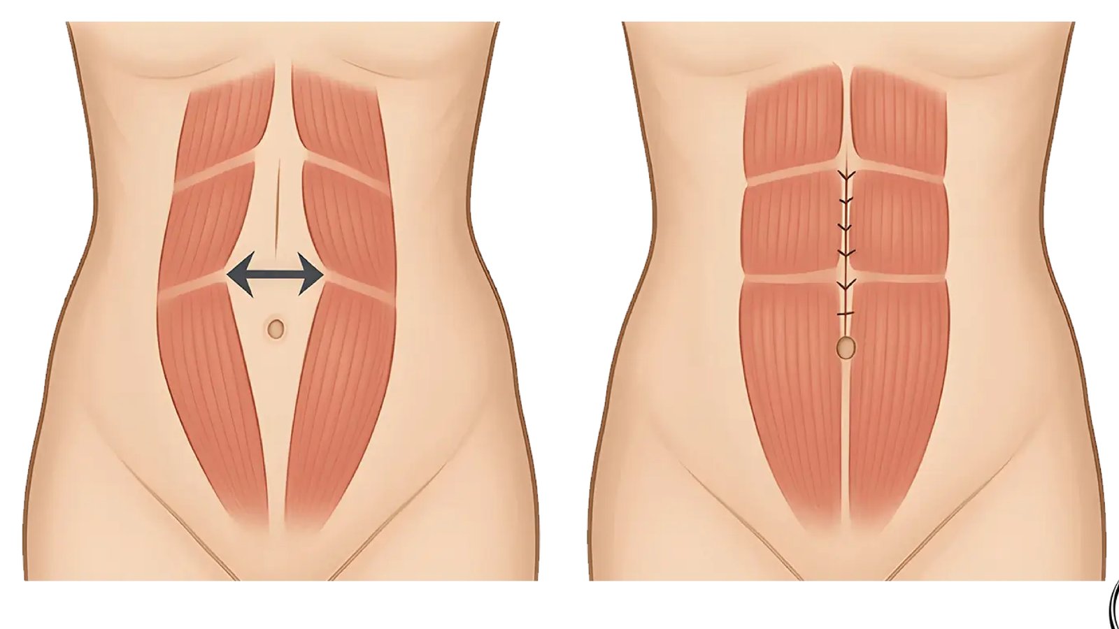 Abdominoplasty