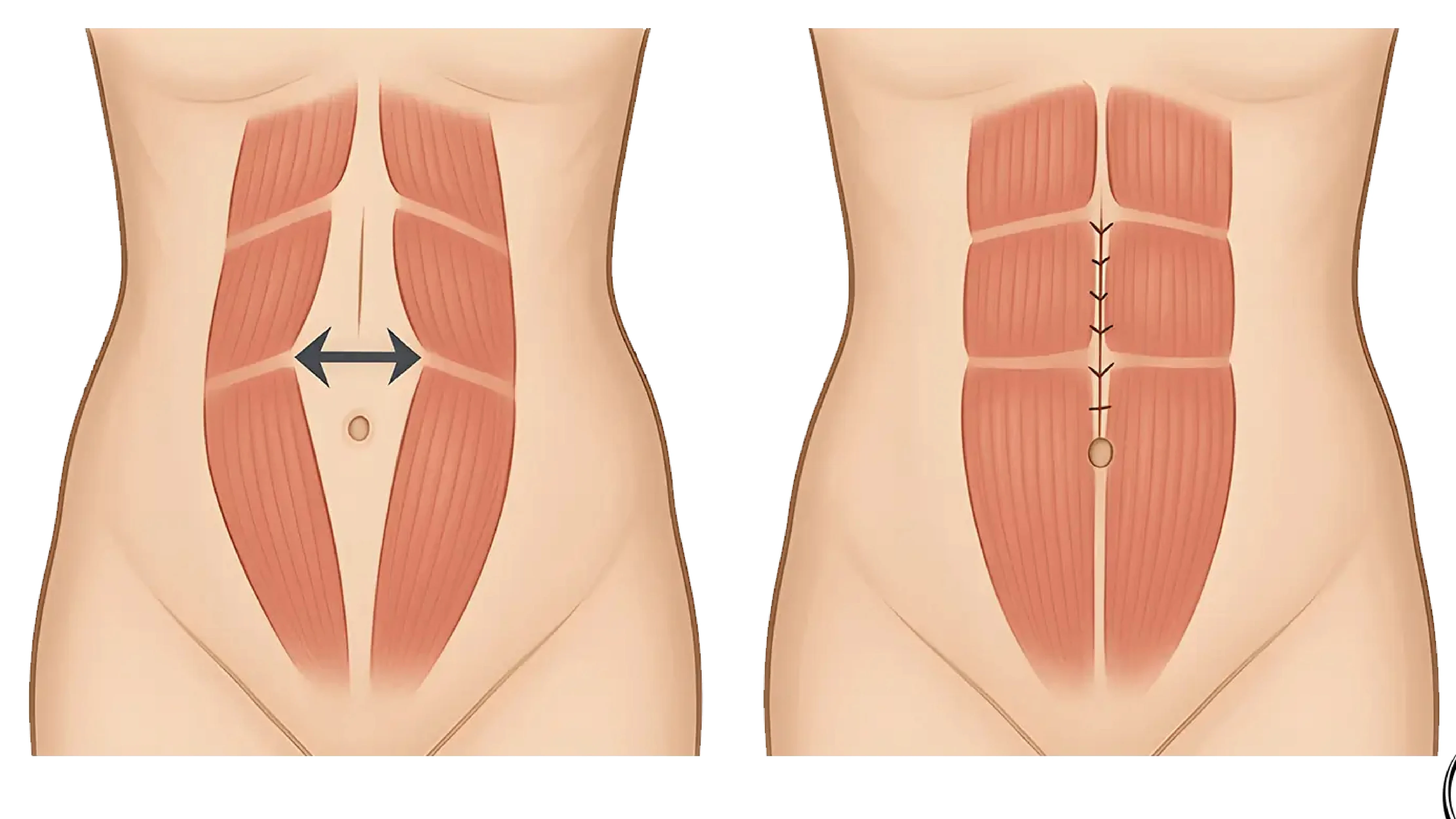Abdominoplasty