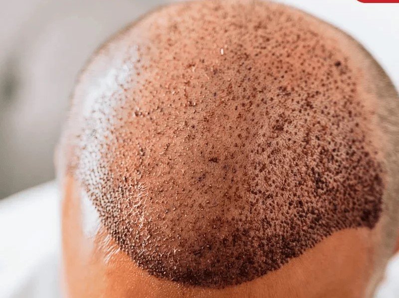  FUE hair transplant treatment