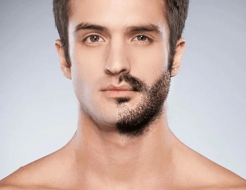 Beard transplant treatment