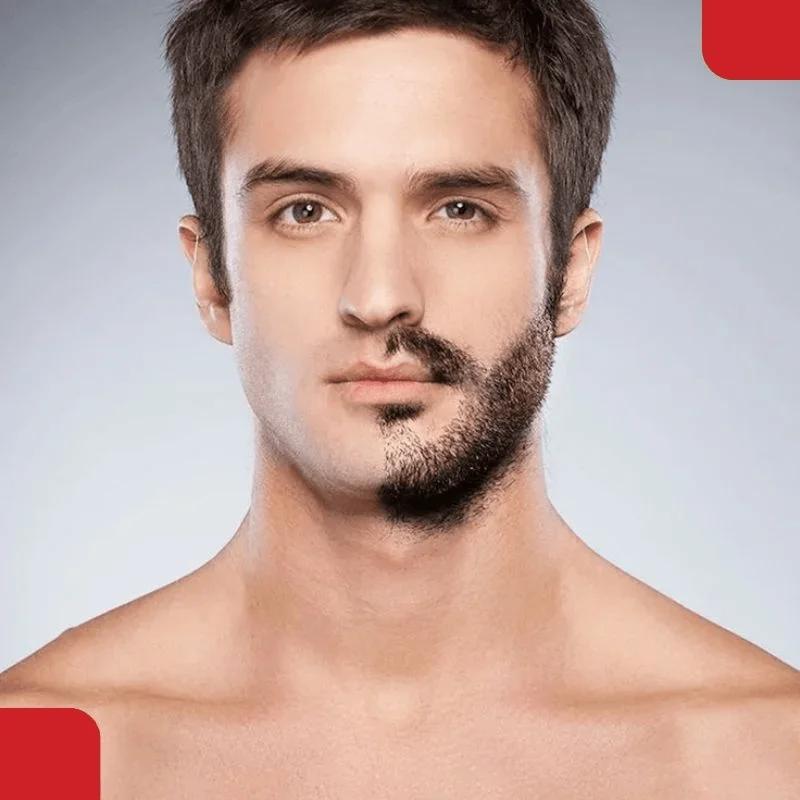 Beard transplant hair placement