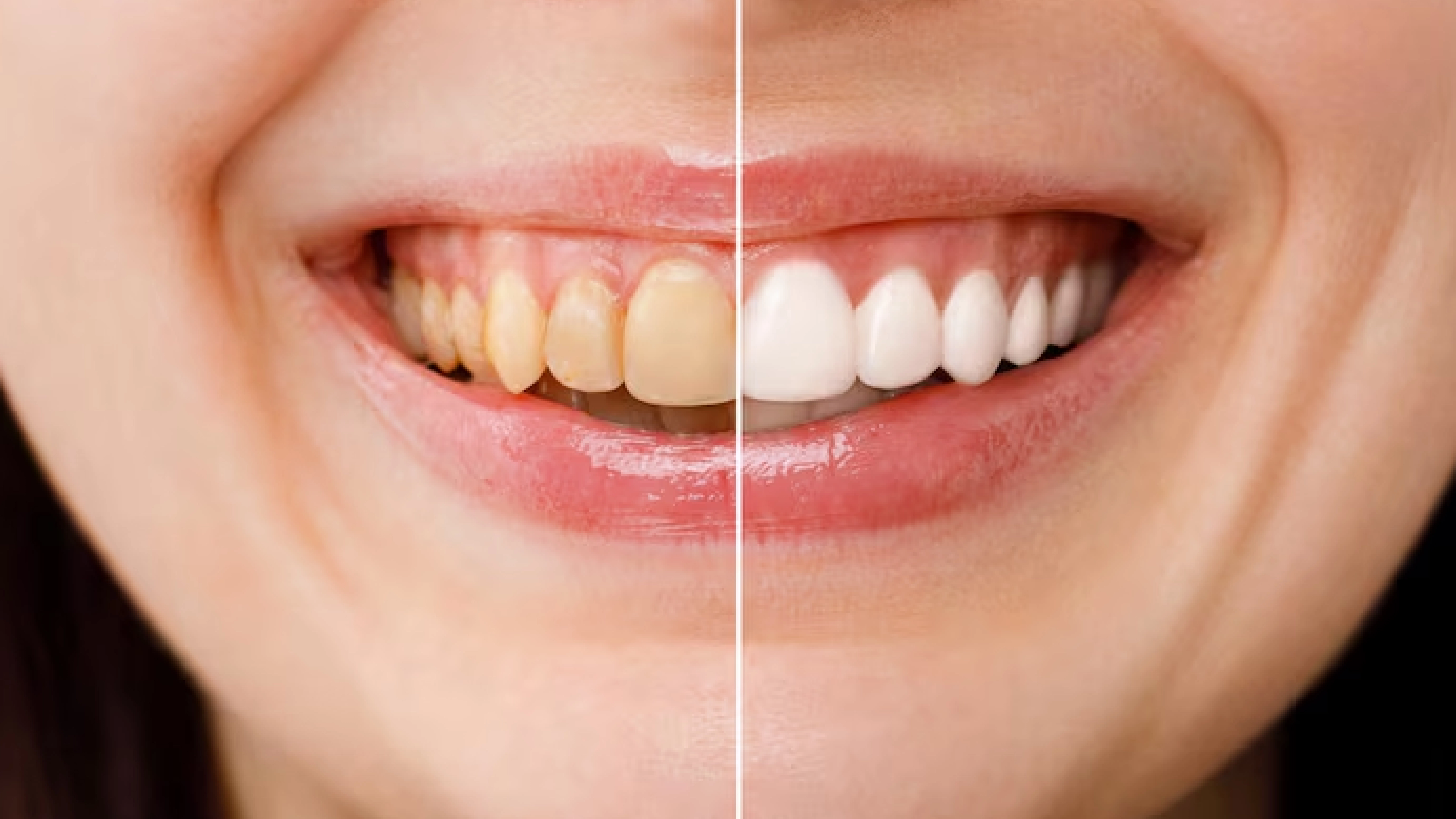 Bleaching treatment