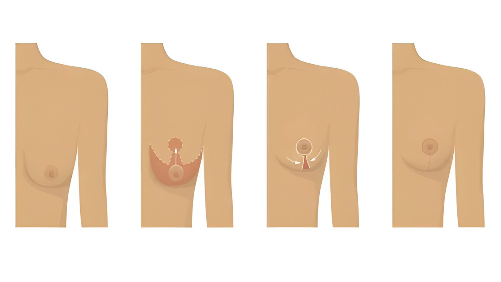 Breast lift treatment
