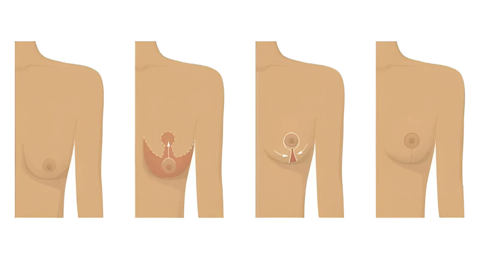 Breast lift