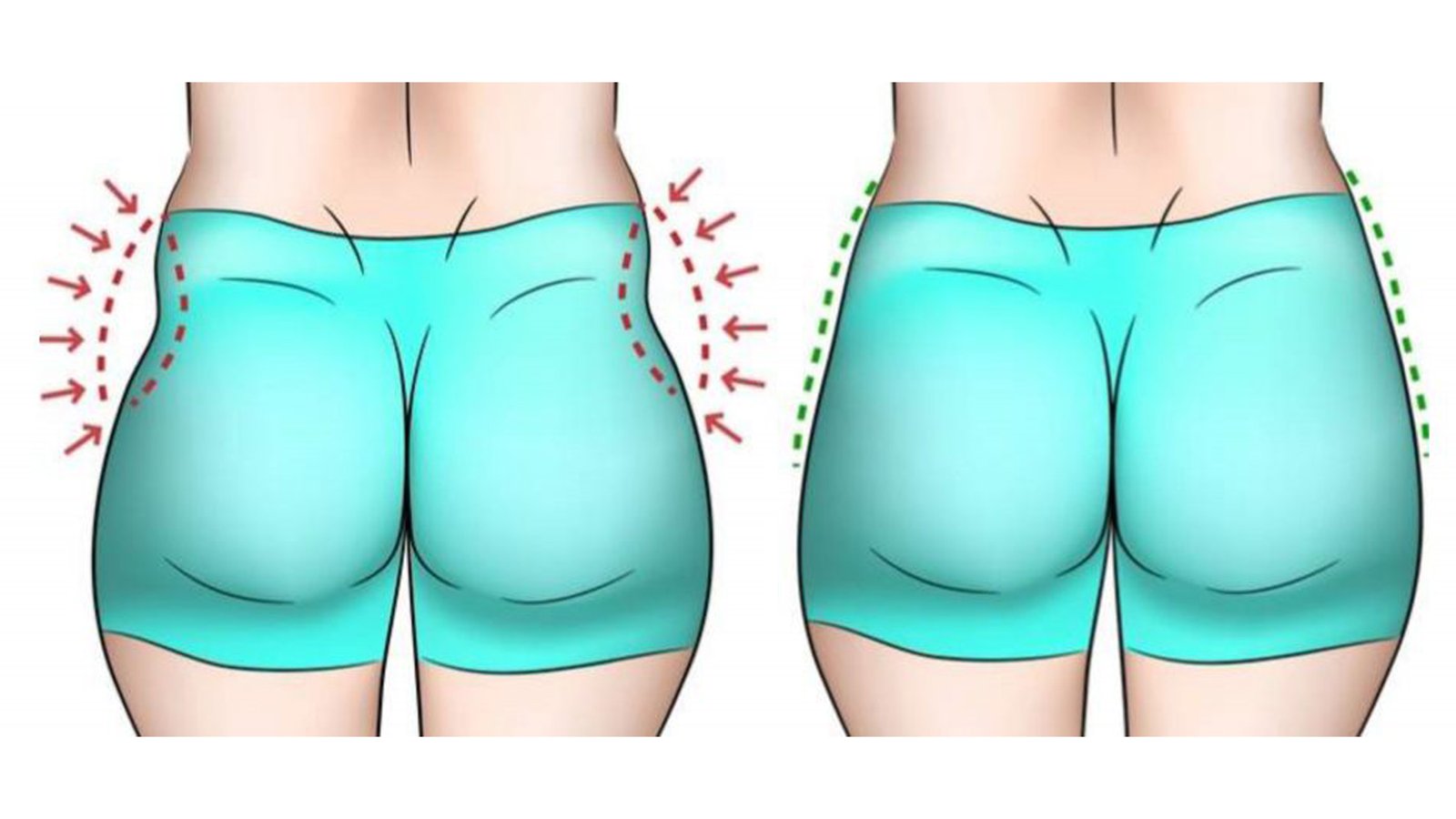 Butt lift treatment