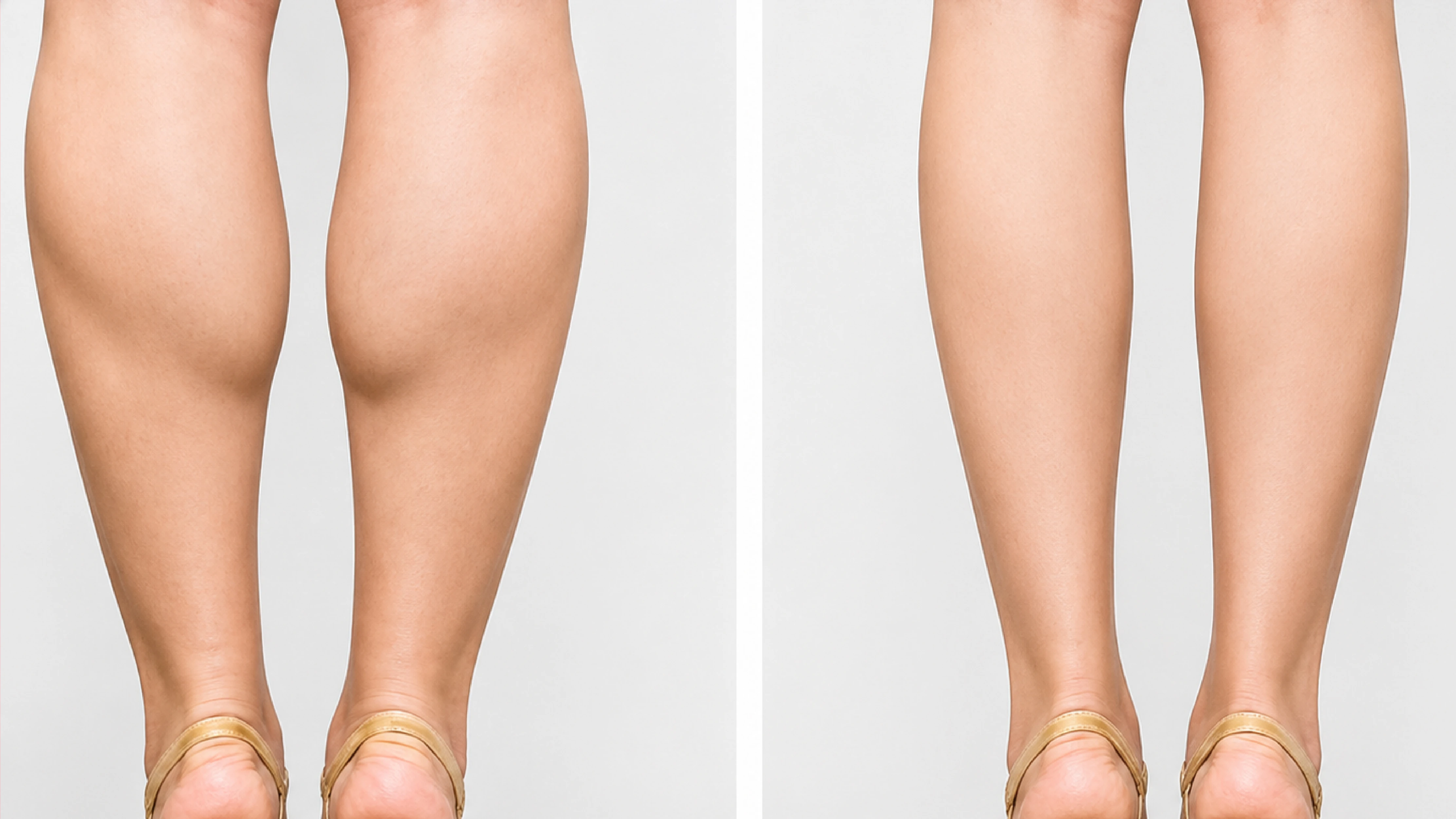 Calf Muscle Reduction