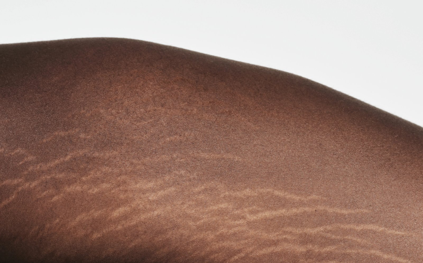 Carboxy Therapy Stretch Mark Reduction treatment