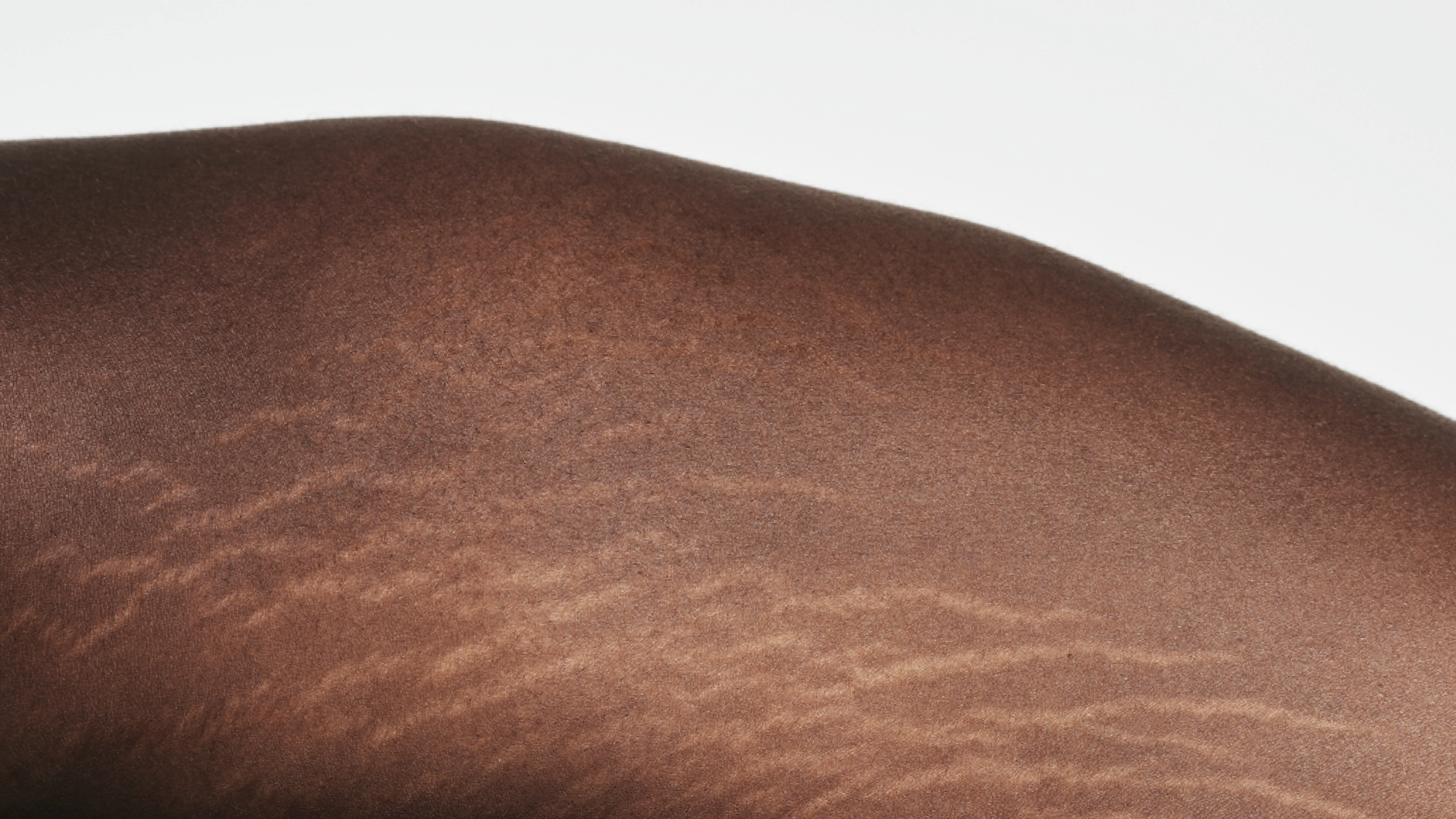 Carboxy therapy stretch mark reduction