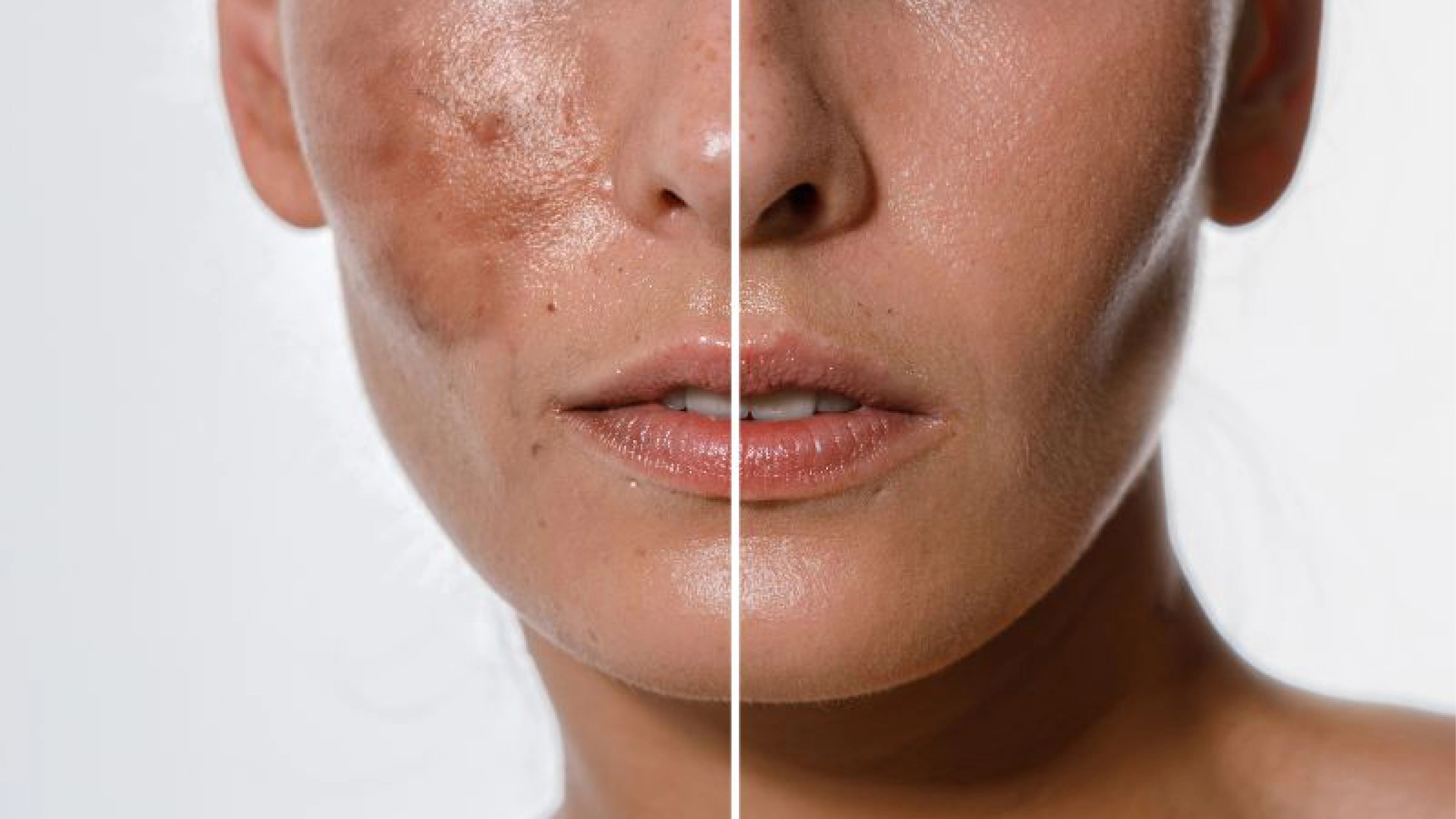Chemical peels for pigmentation