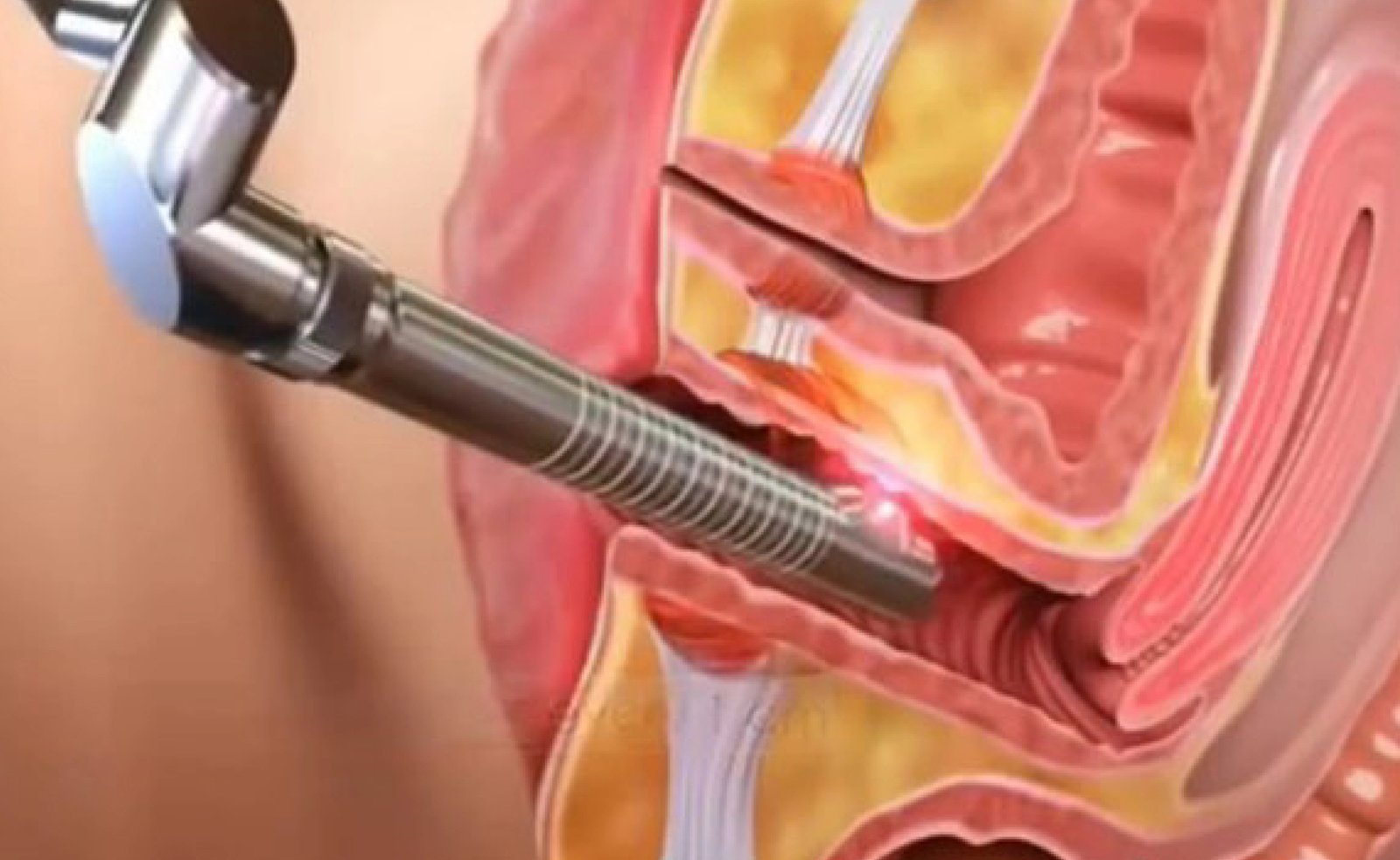 CO2 Laser and RF Genital Rejuvenation treatment