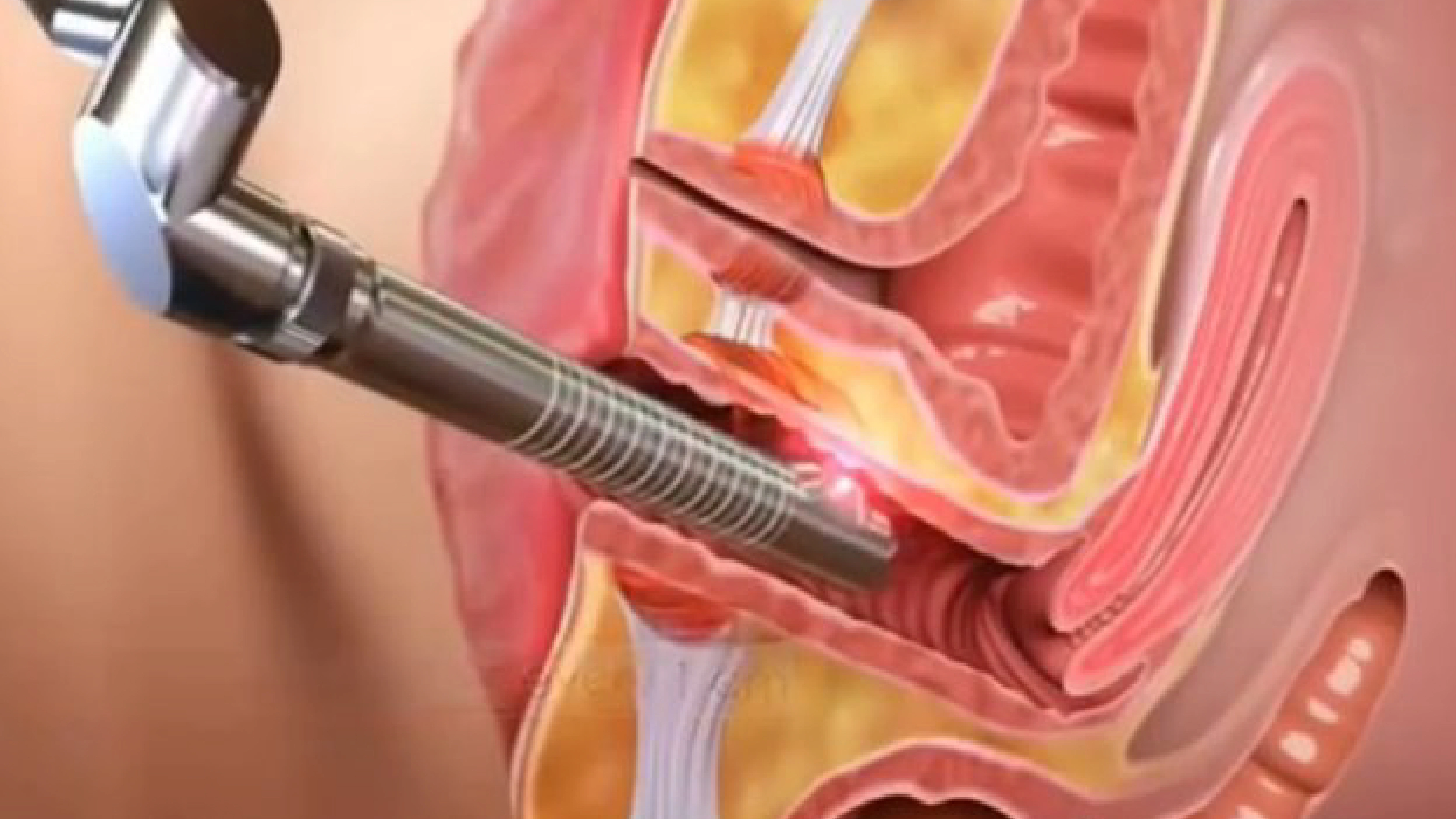 CO2 laser and RF genital rejuvenation