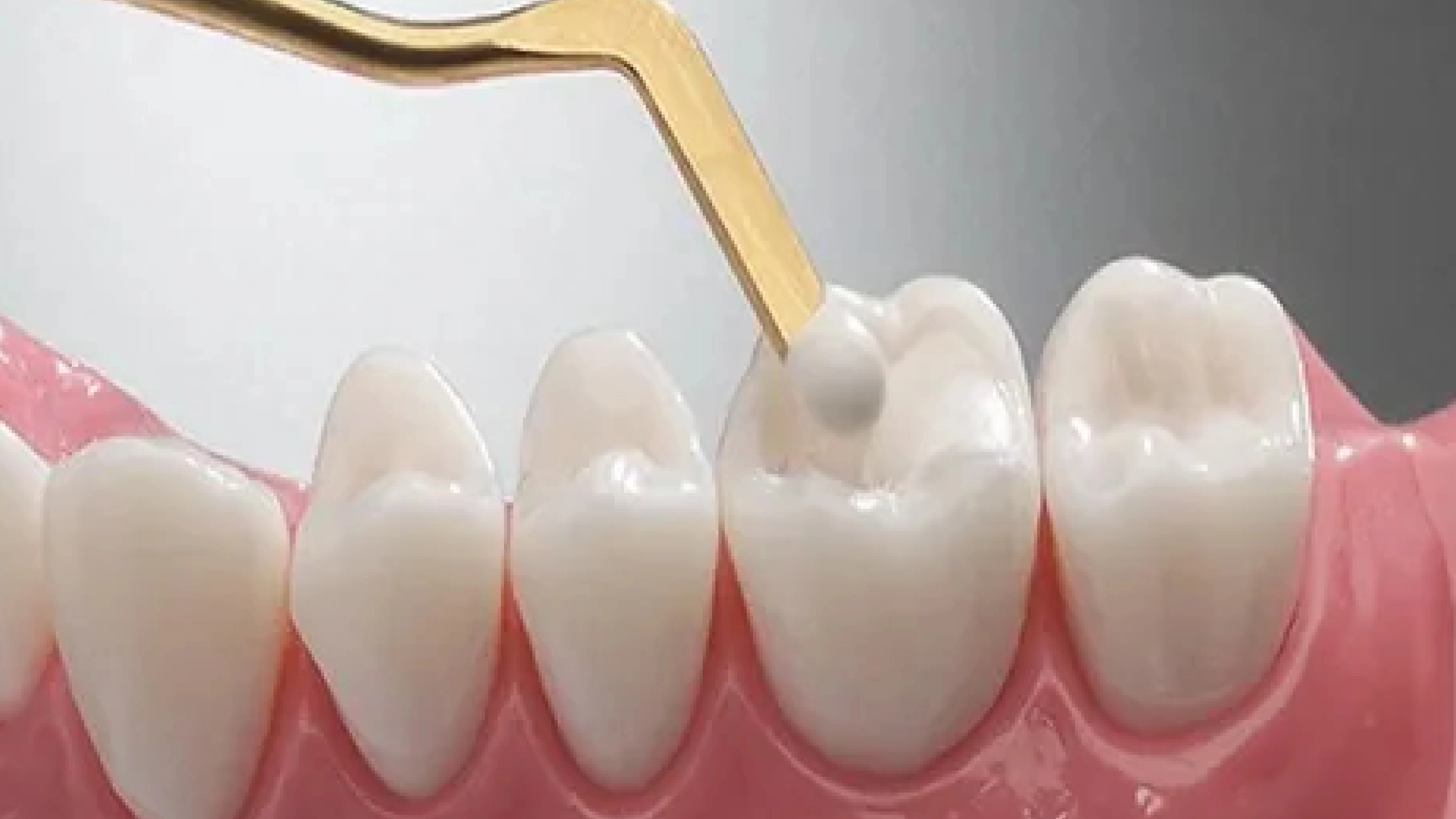 Composite restoration treatment