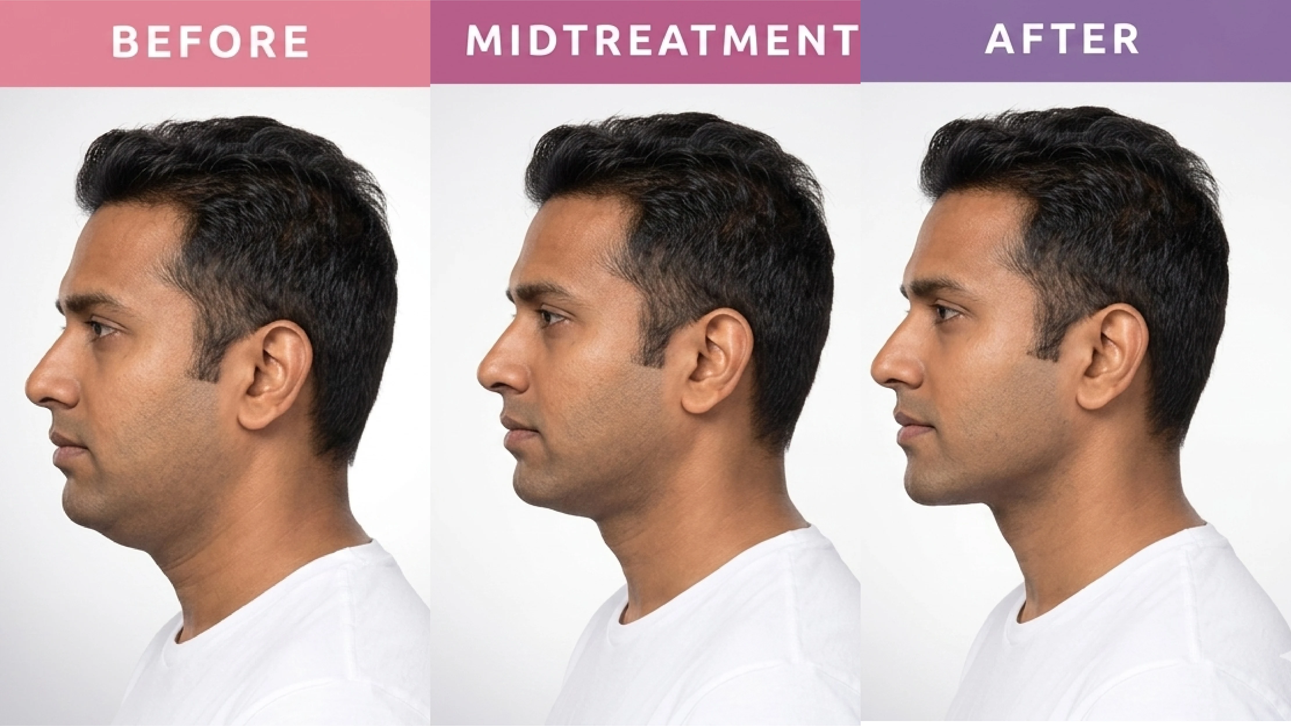 Deoxycholic Acid Double Chin Reduction