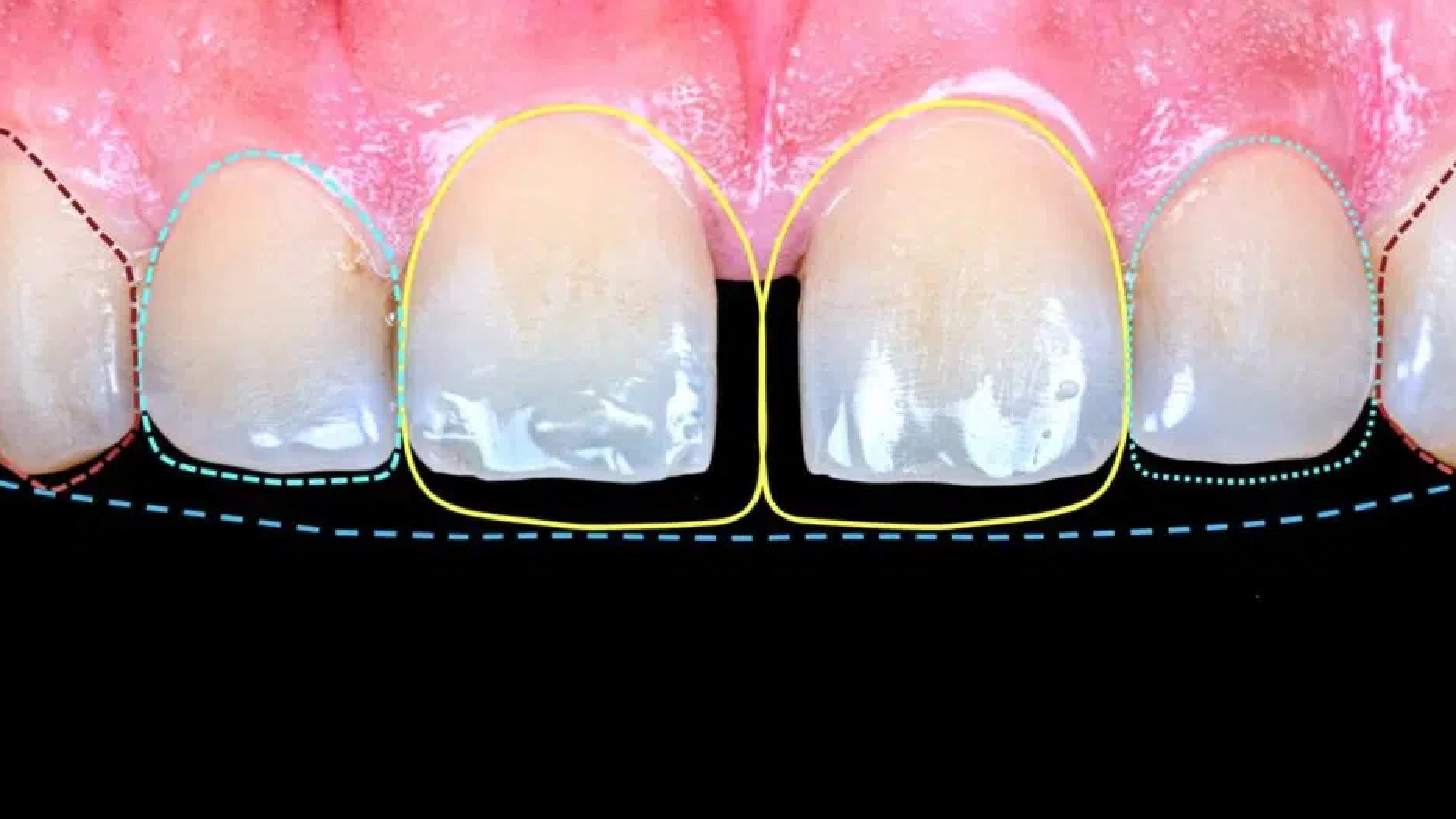 Diastema closure treatment