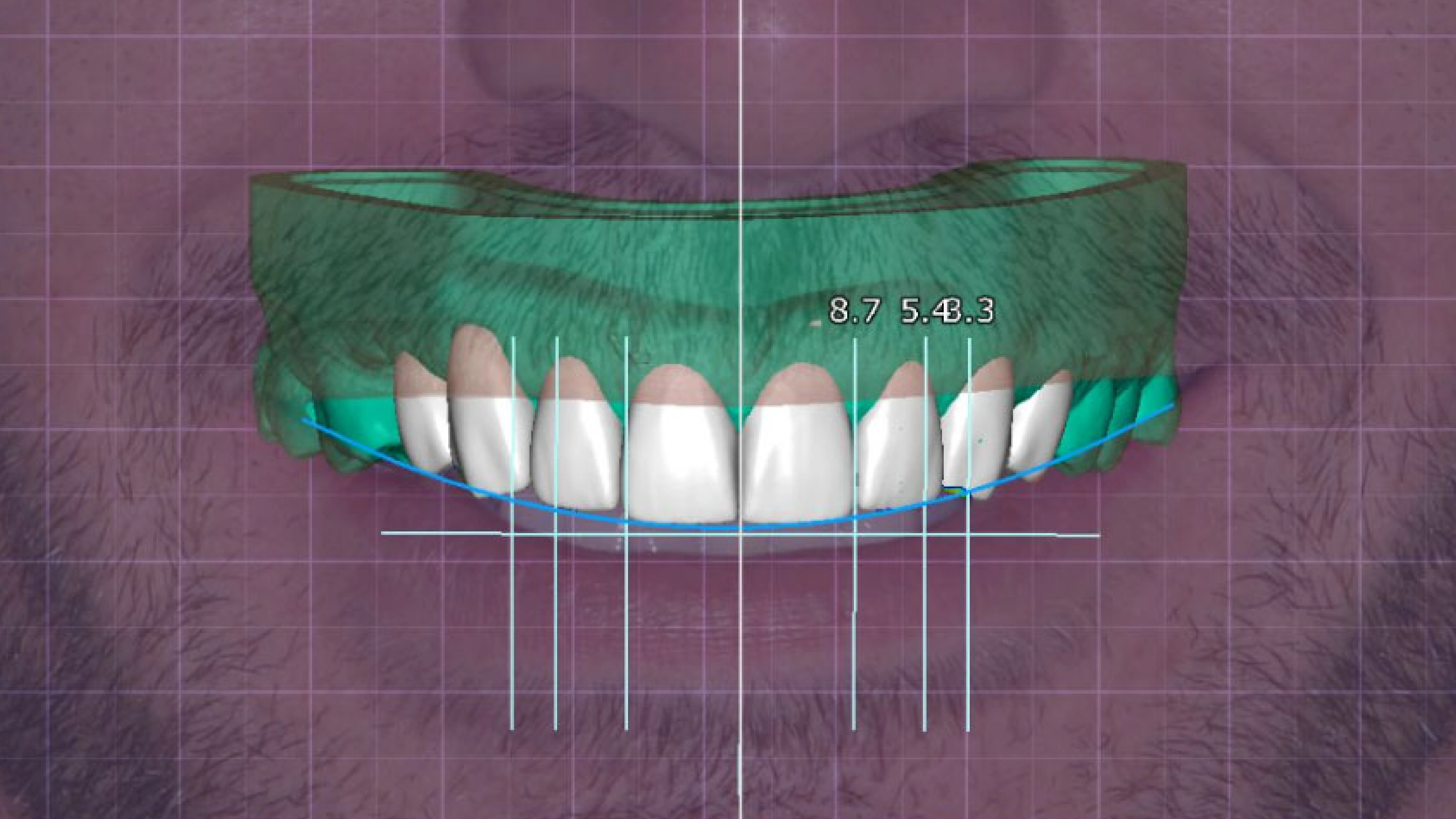 Digital smile designing