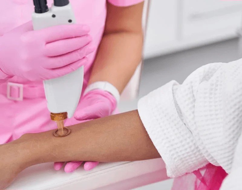 Diode Laser hair removal