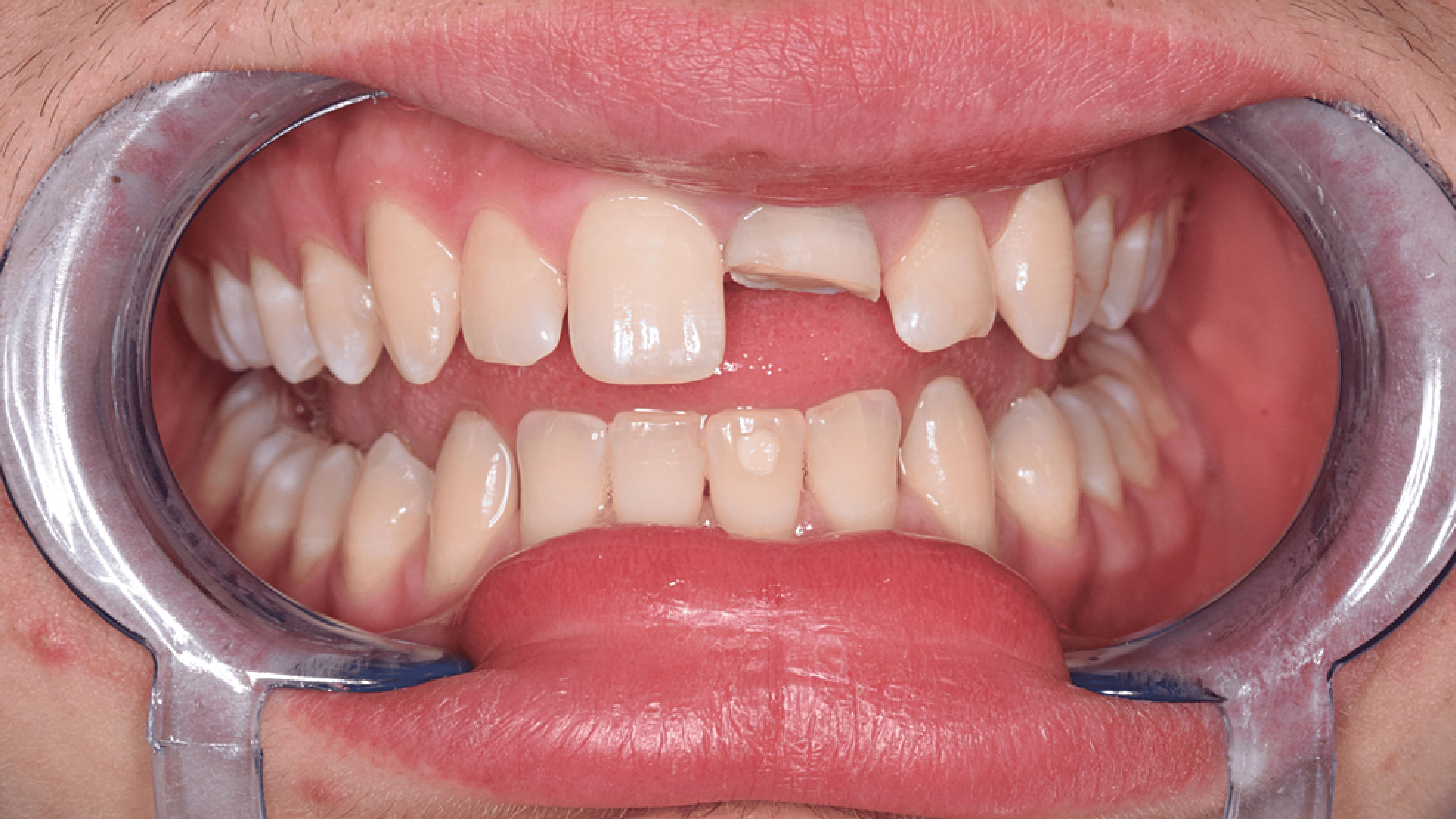 Ellis fracture repair treatment