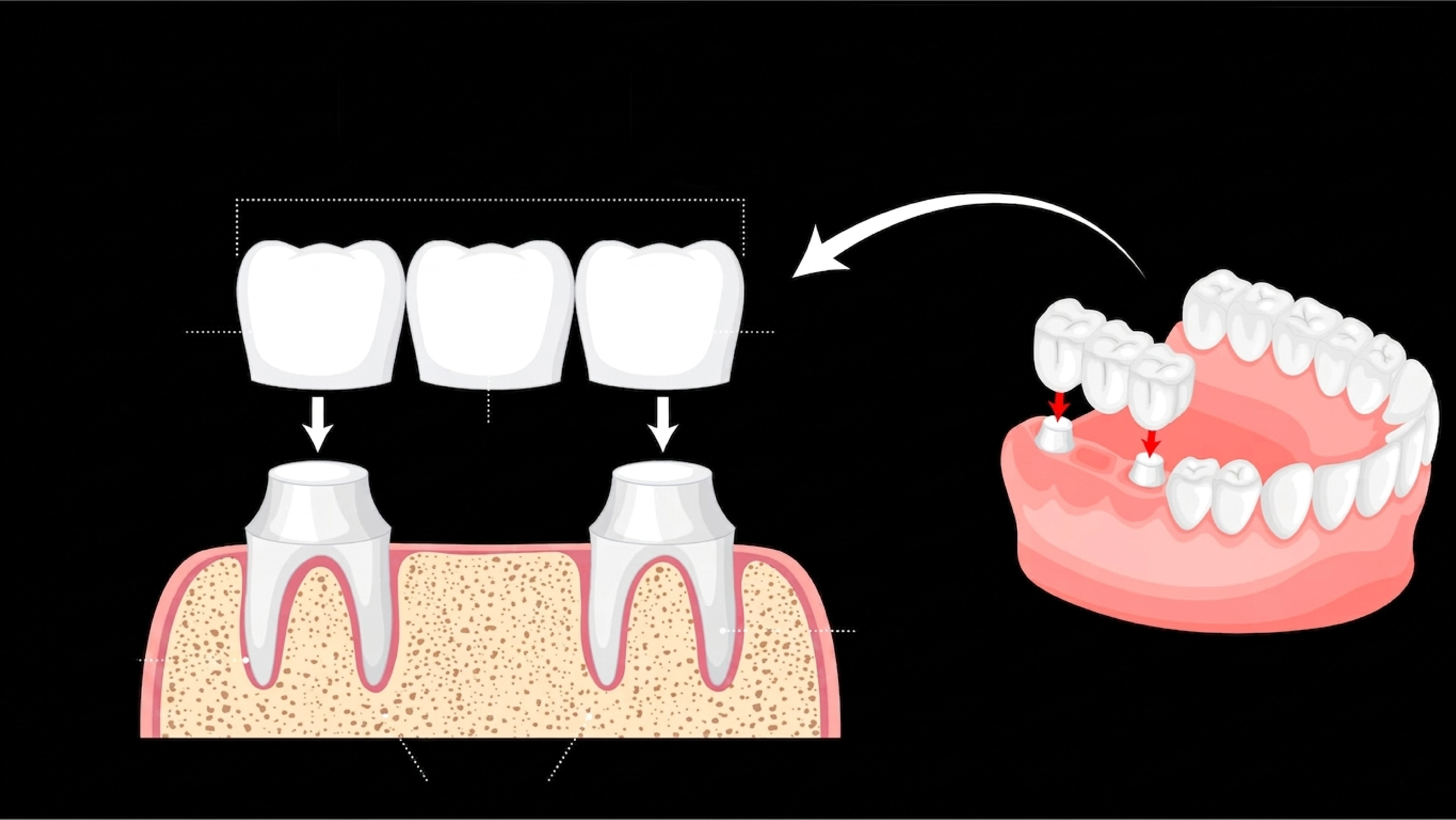 Fixed partial denture crown and bridge