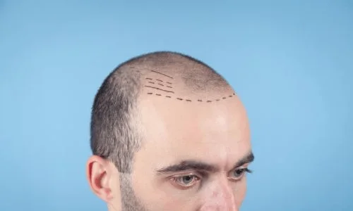 FUE follicle extraction and placement