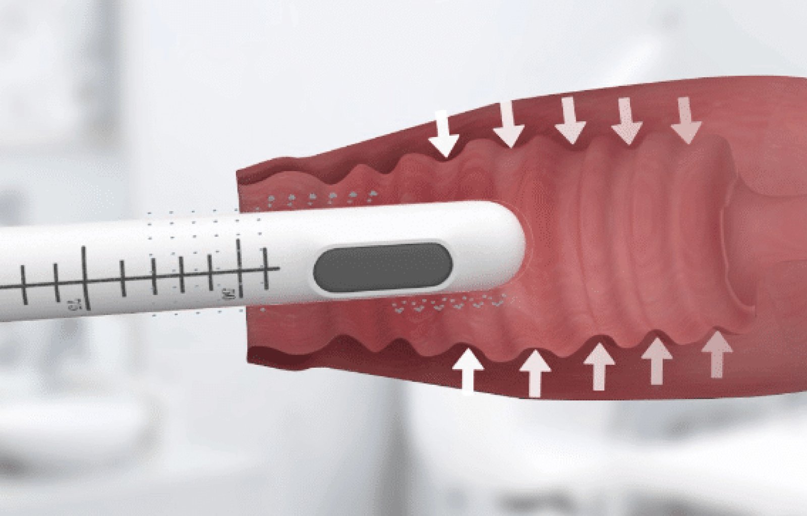 HIFU Vaginal Tightening treatment