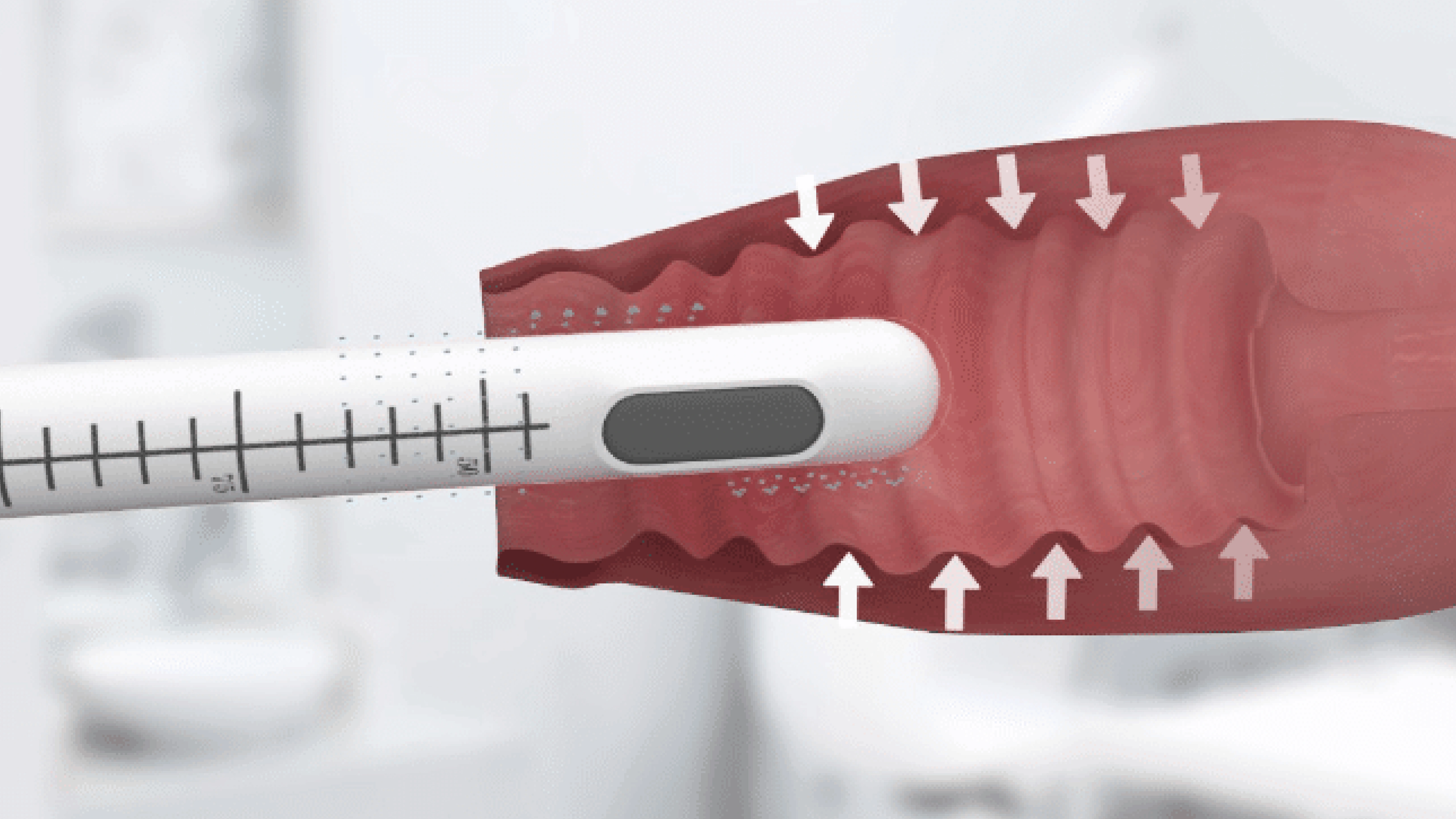 HIFU vaginal tightening