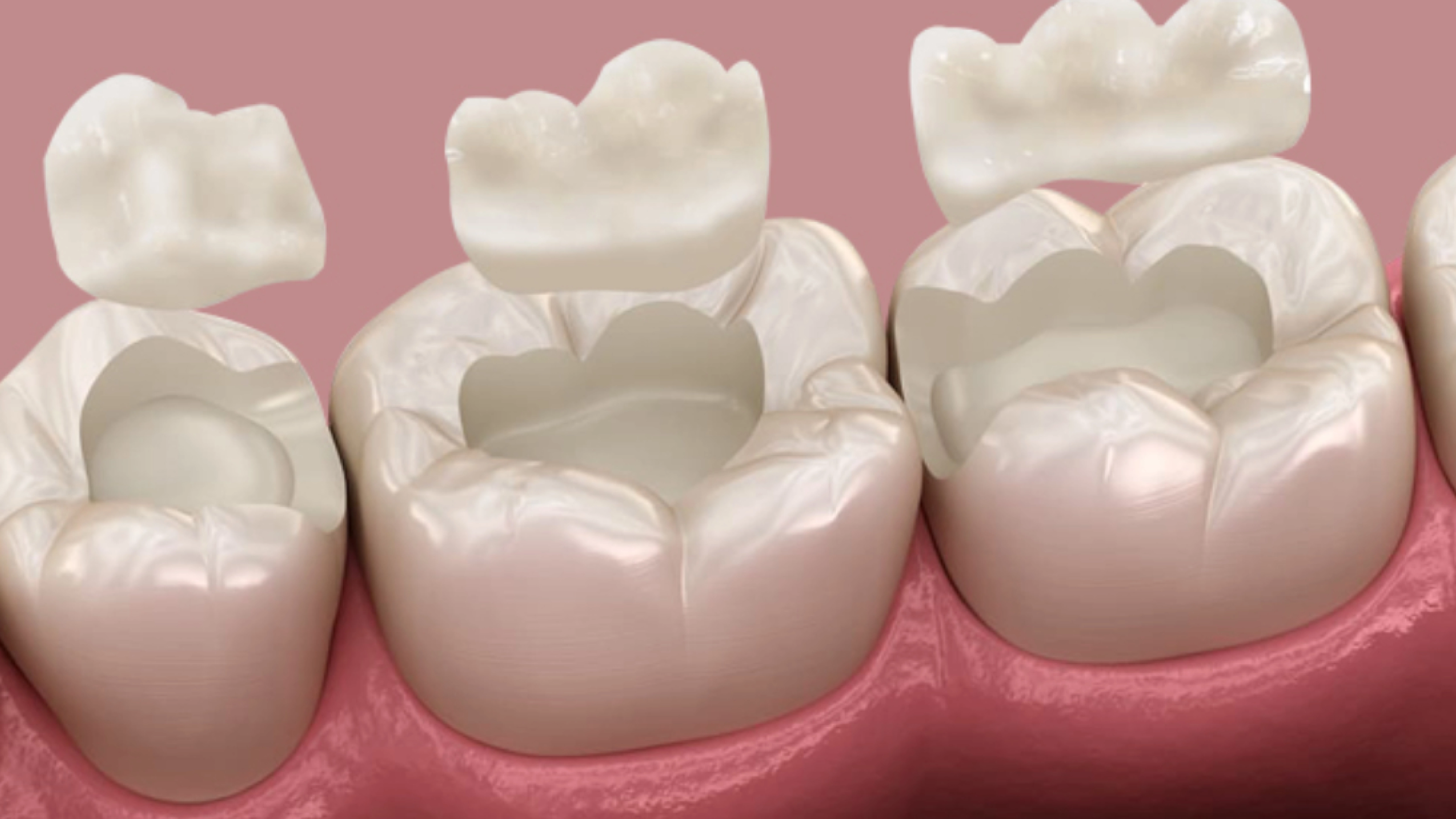 Inlays and onlays treatment