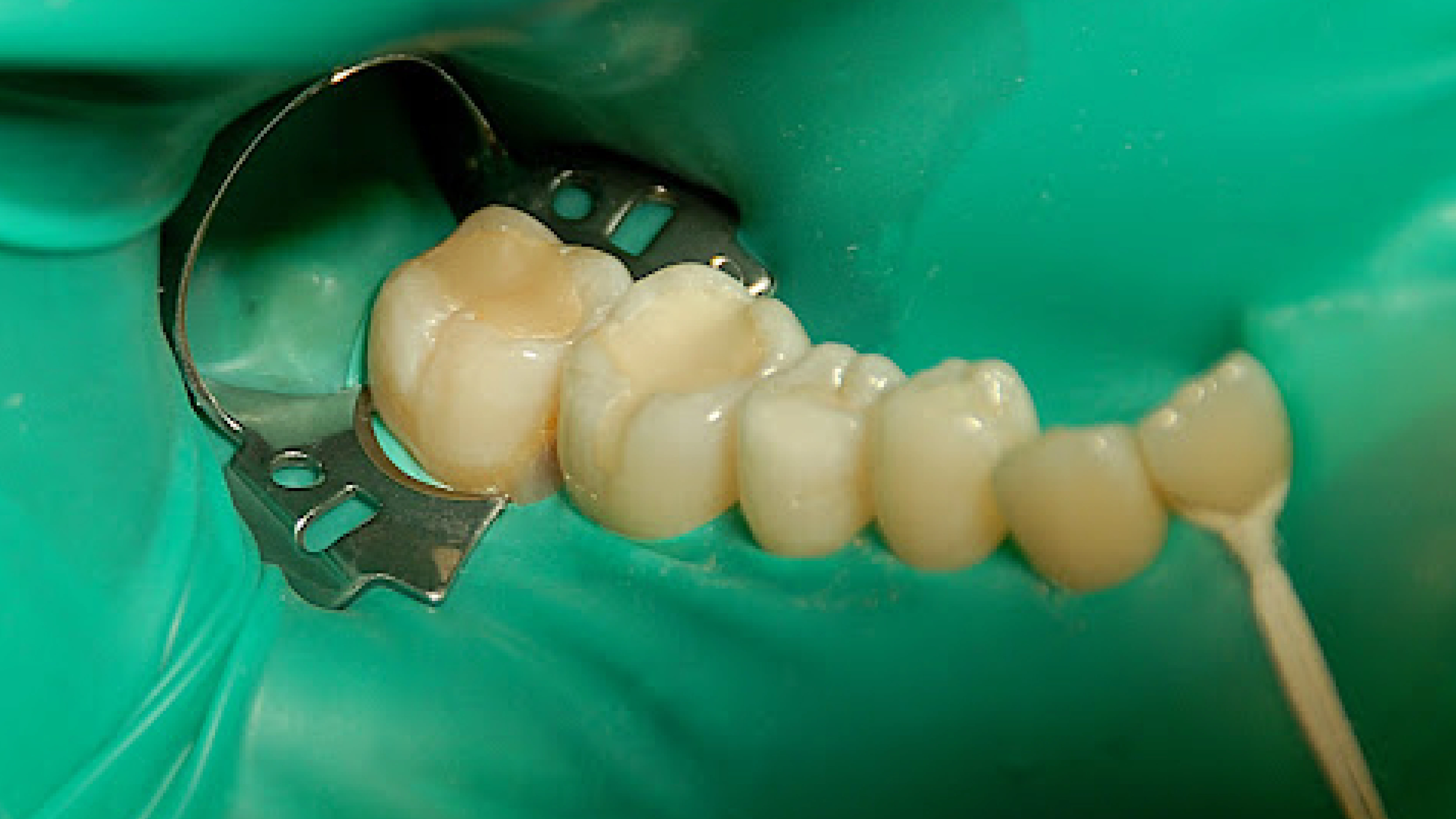 Isolation and rubber dam treatment