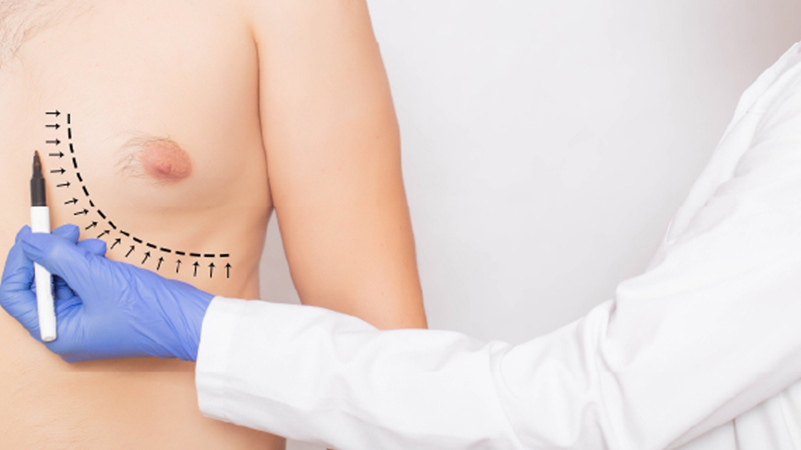 Male breast reduction