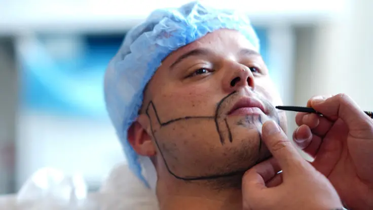 Moustache transplant results