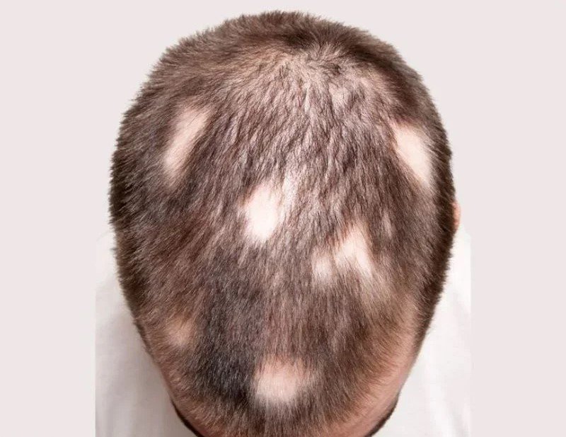 Partial Alopecia treatment