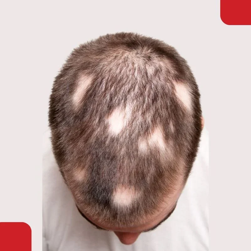 Partial alopecia treatment