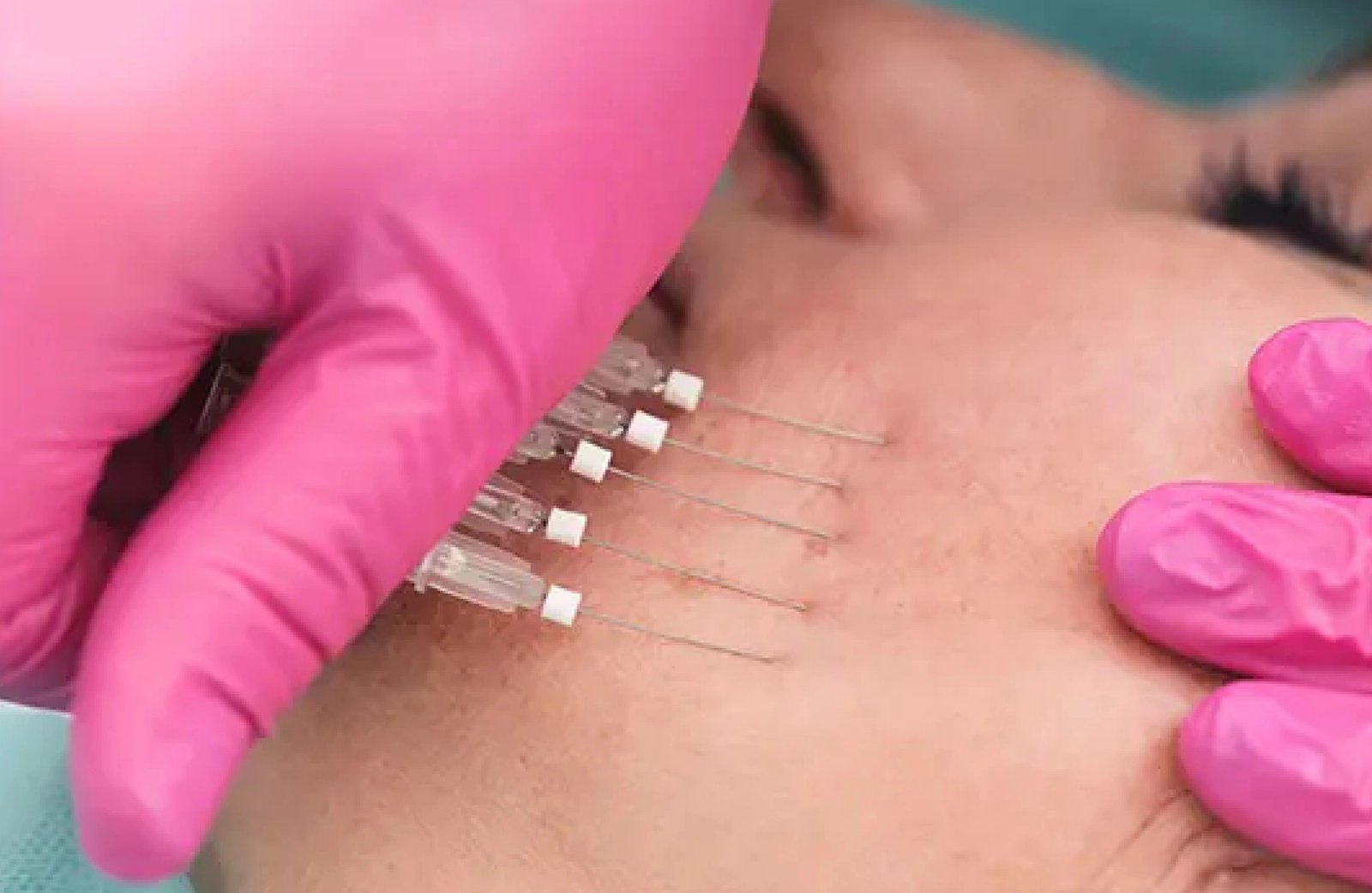 PDO Threads Vaginal Application and Body Contouring treatment
