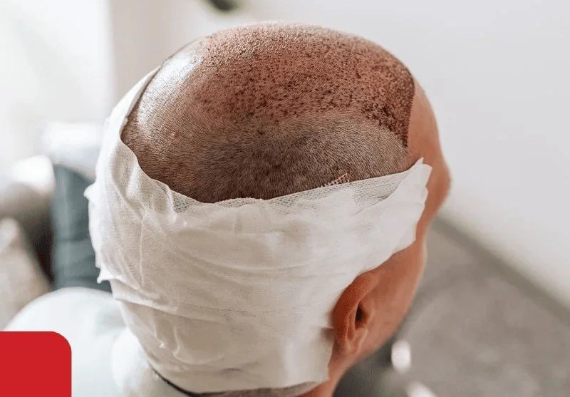 Percutaneous FUE hair transplant treatment