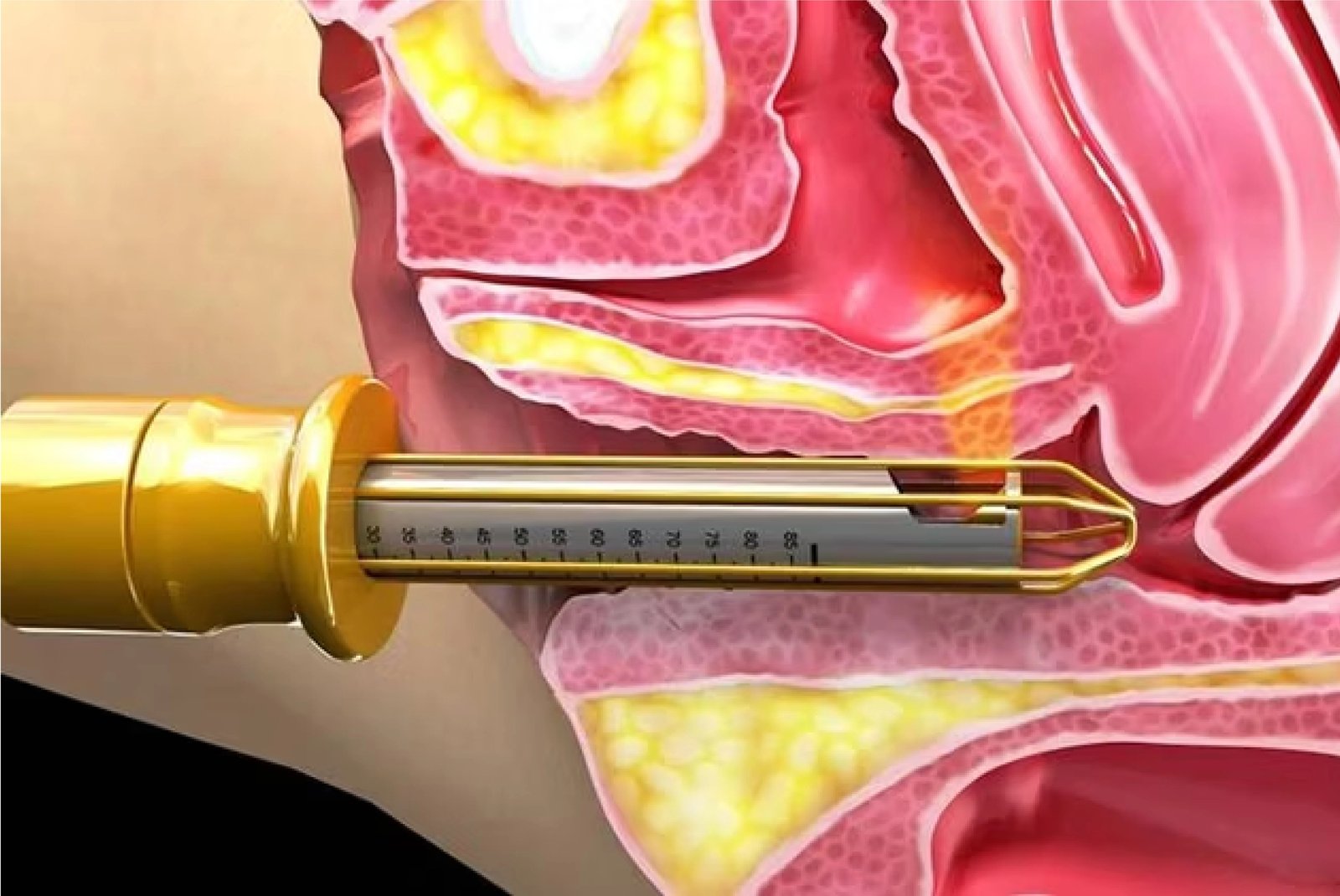 PRP and Laser Treatment for Urine Incontinence treatment