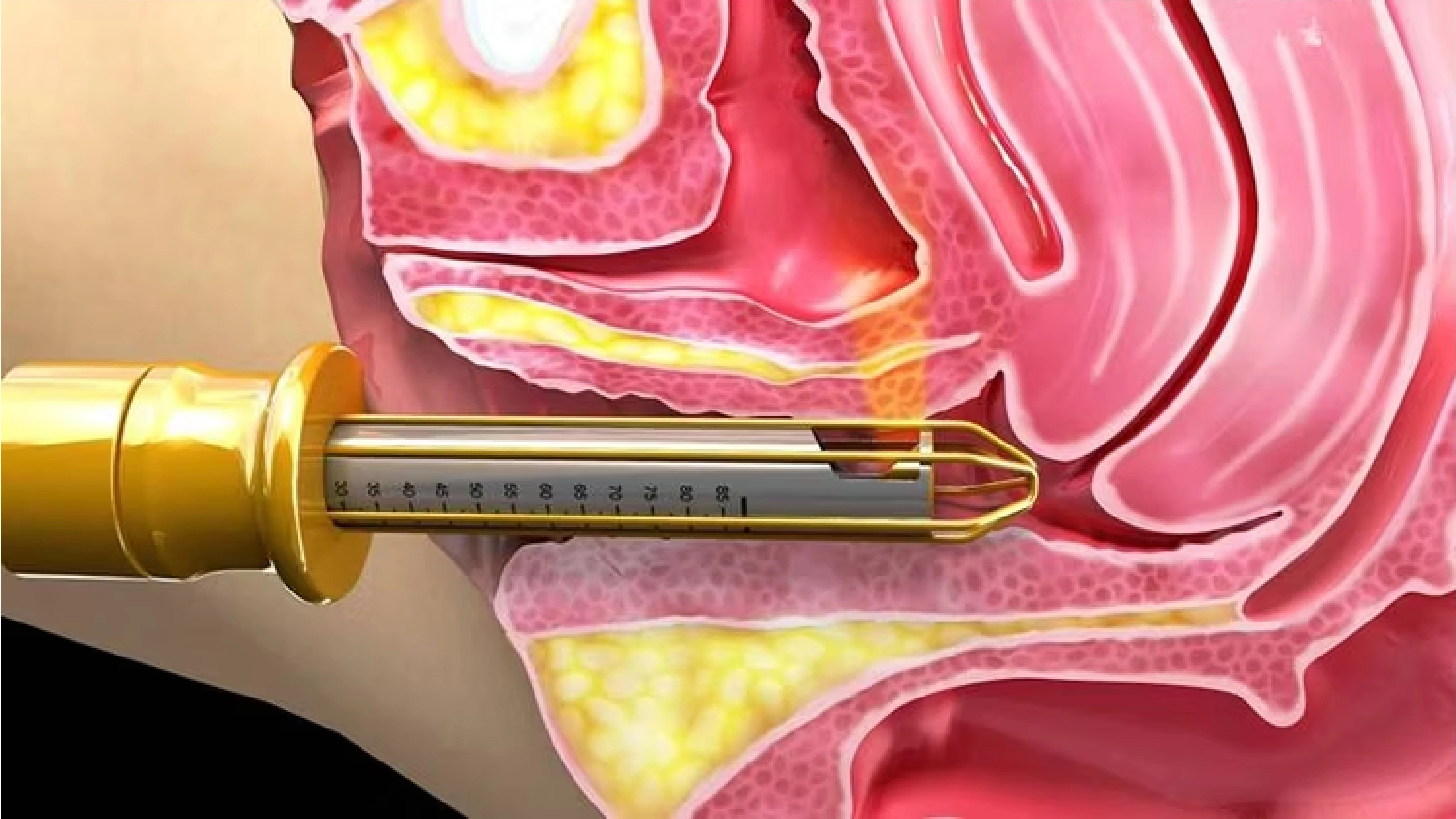 PRP lasers non surgical management of urine incontinence