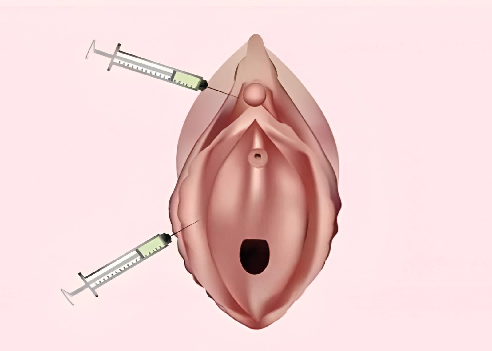PRP Vulvo Vaginal Rejuvenation and O Shot treatment