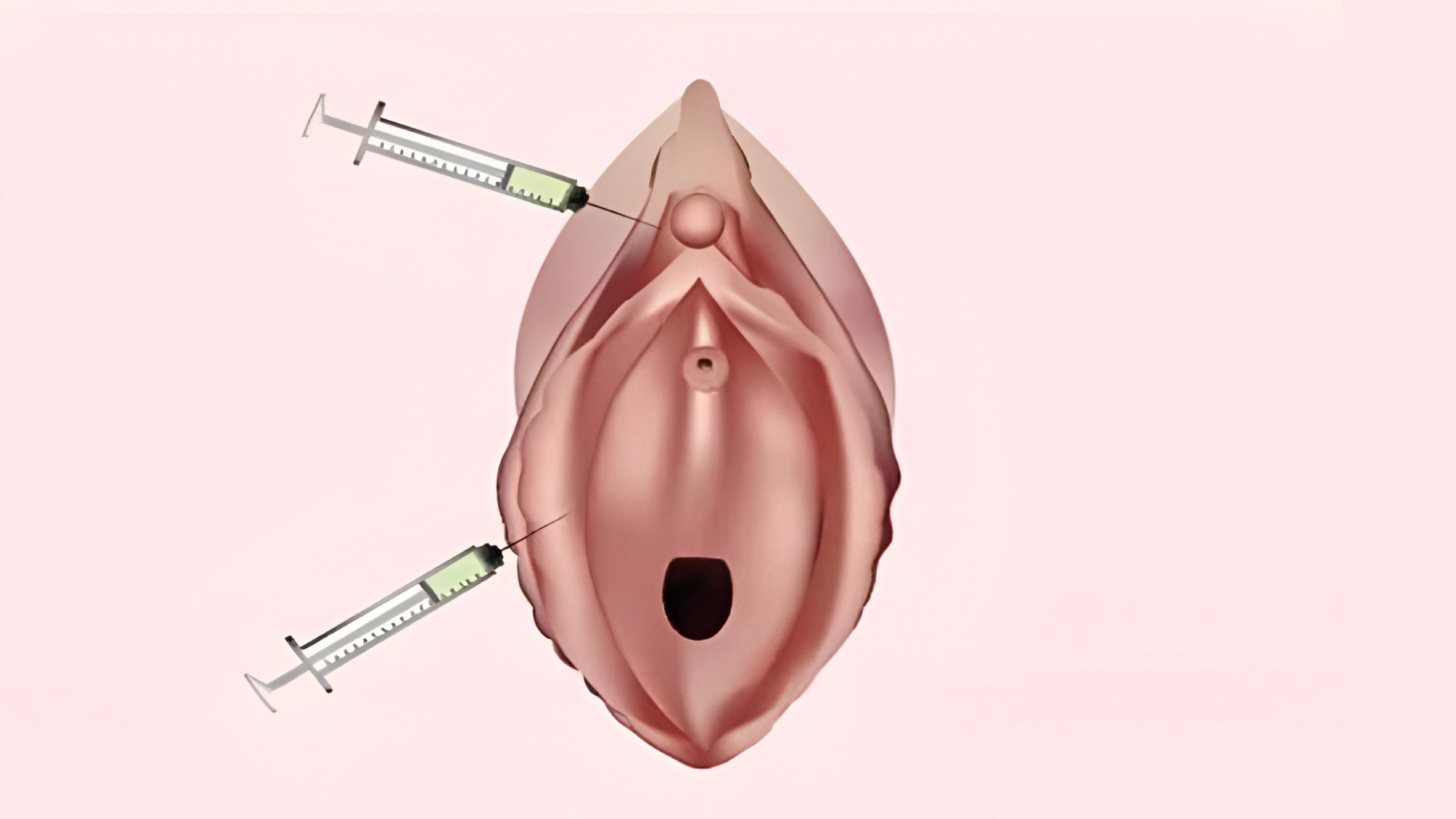 PRP Vulvo vaginal rejuvenation and O shot