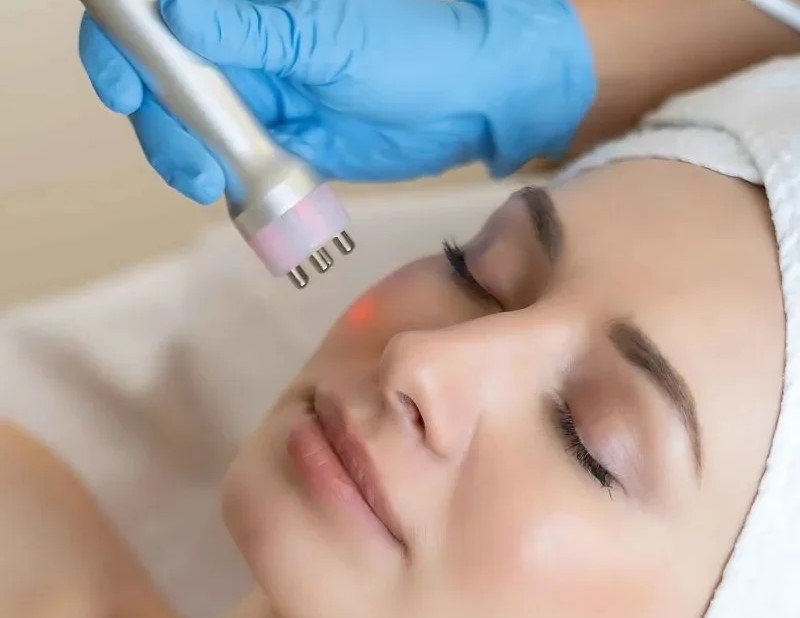 RF Facials treatment