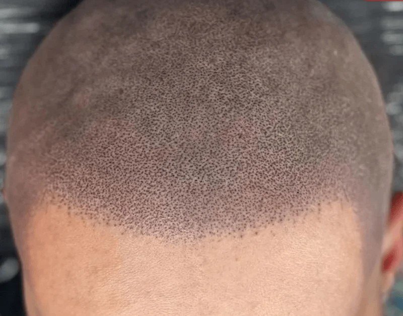 Scalp Micropigmentation treatment
