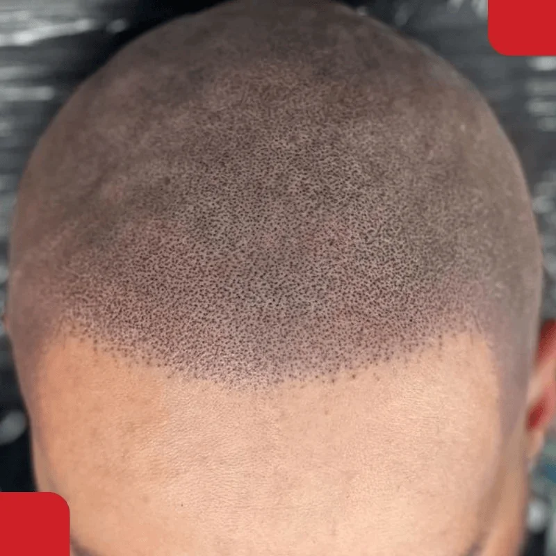 Scalp micropigmentation treatment
