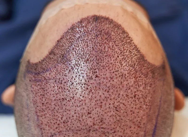 Titanium FUE hair transplant treatment